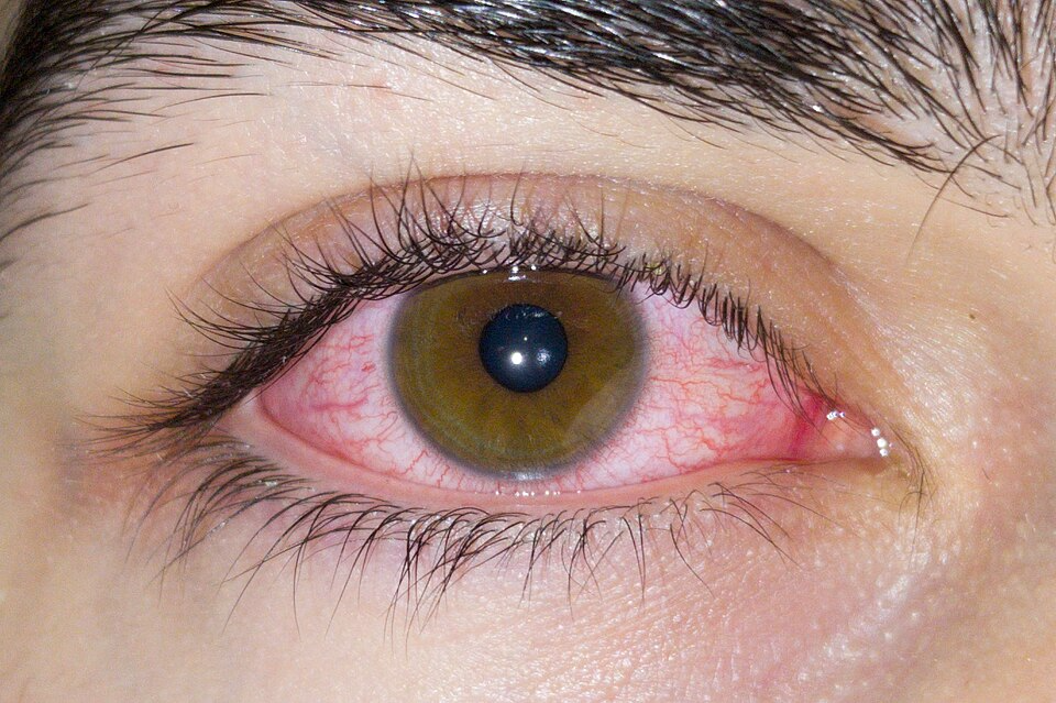 Eye Allergies