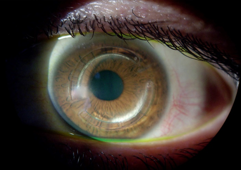 Corneal Scar